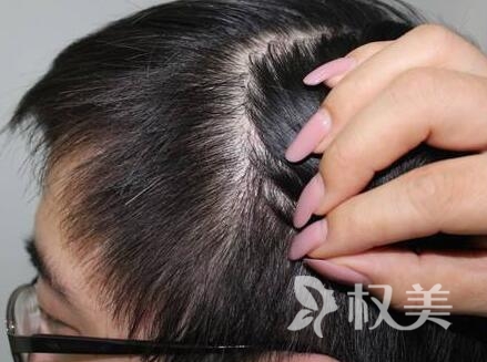 斑秃的最佳治疗方法是什么 疤痕植发多久见效