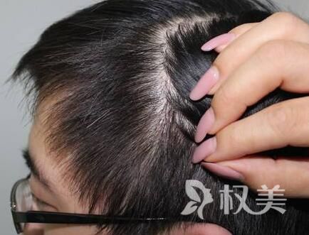 斑秃的原因及治疗 疤痕植发优势有哪些