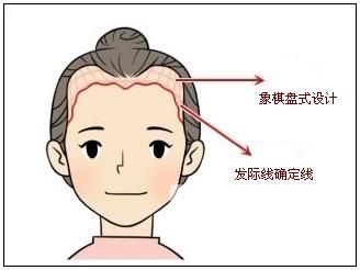 植入的头发成活率高吗 发际线种植痛不痛
