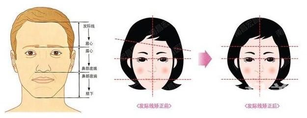 ​女性发际线太高怎么办 发际线种植效果怎么样