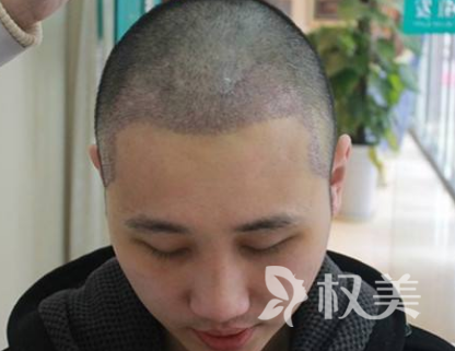 发际线种植后移无需烦恼 发际线种植帮你解决问题