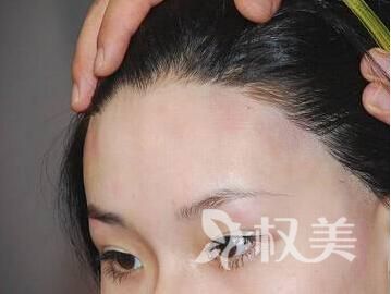 前额头发少怎么办 发际线种植效果好吗