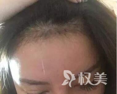 掉头发什么原因 发际线种植多久有效果