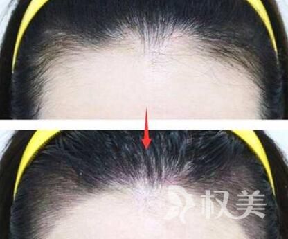 成都碧莲盛医院电话 美人尖种植价格