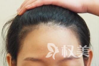 治疗脱发的偏方有哪些 发际线种植能维持多久