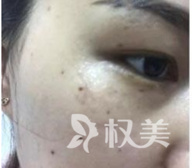 激光祛斑一个月后让我的脸上光滑无痕 恢复了过去的好肌肤