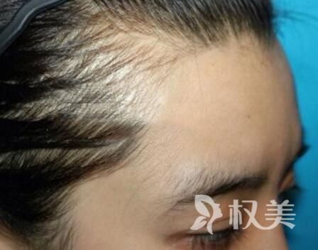 发际线是什么 广州做发际线种植需要多少钱