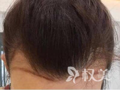 肥胖性脱发怎么办 北京发际线种植哪里好