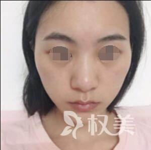 亲身经历去颊脂垫手术  让我摆脱“婴儿肥”