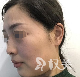 分享我在贵阳利美康做面部吸脂瘦脸术 美与不美就在一念间