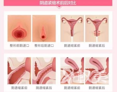 福州第八医院整形科阴道紧缩有哪些优势  术后要怎么护理