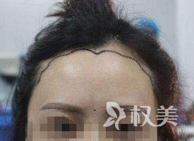 北京碧莲盛植美人尖多少钱 会不会很贵