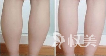 如何减小腿 滨州华美医学整形吸脂术让你告别“罗圈腿”