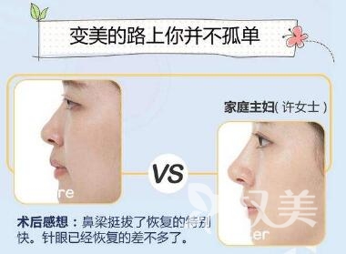 金华东阳中医院整形科做假体隆鼻术后会不会留疤呢  可以维持多长时间