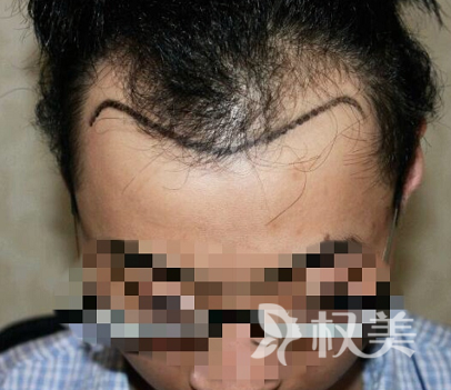 杭州雍禾植发医疗整形医院发际线种植案例 终于不再显老了