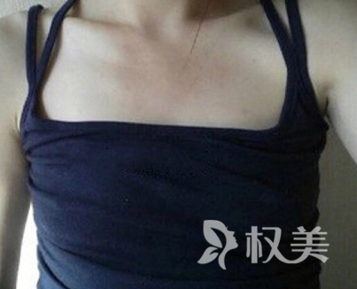 深圳维多利亚整形医院的假体隆胸经历 产后妈妈的华丽变身