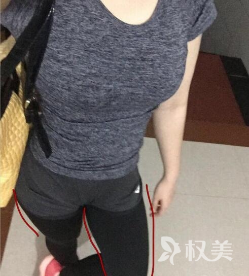 专业吸脂减肥 我选择北京中日友好医院整形外科 大象腿速变筷子腿就这么简单