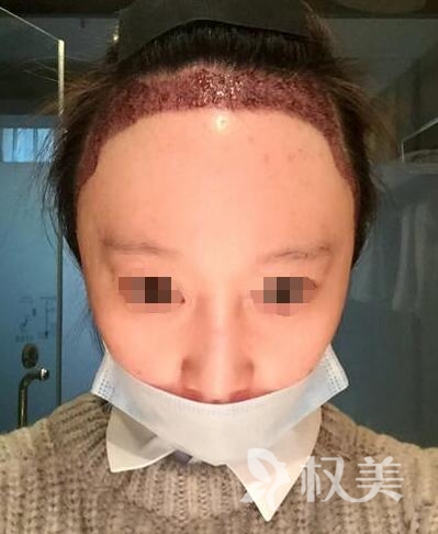 广州倍生女性发际线调整案例