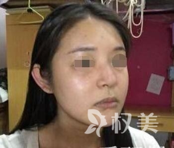 杭州芭黎整形医院鼻综合案例  我也是个精致的小仙女了