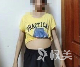 我在上海美尔雅整形医院做了腰腹吸脂 终于不再让别人误以为我是孕妇了