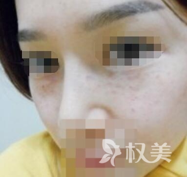 天津第三中心医院美容科激光嫩肤后日晒痕迹不见了 肌肤更加白皙透亮