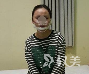 深圳睿京医疗美容医院假体隆下巴案例  拥有下巴  感觉像是变了一个人