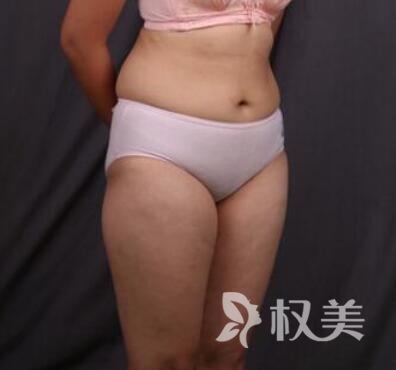 我的吸脂经历：广州美莱整形医院腰腹+大腿吸脂 终于摆脱了臃肿的身材