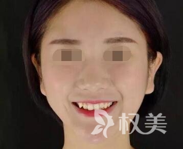 天津时光整形美容医院牙齿矫正案例  拥有整齐牙齿 露出灿烂笑容