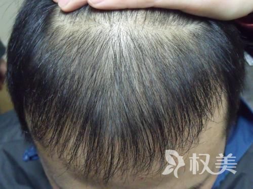 植发手术后忌口需要多久 杭州天大植发科发际线种植贵吗