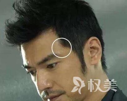 广州韩妃整形医院植发成活率高吗 鬓角种植效果怎么样