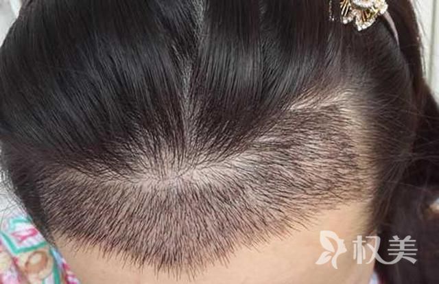发际线种植有后遗症吗 重庆欧亚毛发种植医院效果持久吗