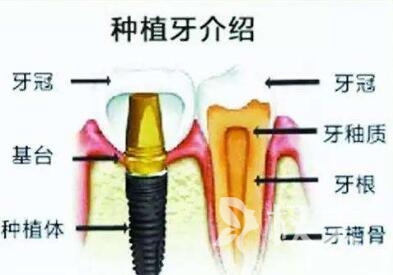【牙齿种植】微创种植牙/牙齿美白/整形活动价格表