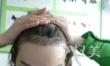 郑州美莱植发医院头发种植效果怎么样呢  术后该怎么护理