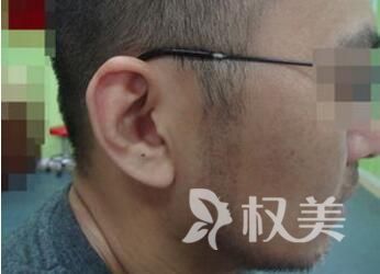芜湖伊莱美整形医院植发科鬓角种植术的优势  植发过程