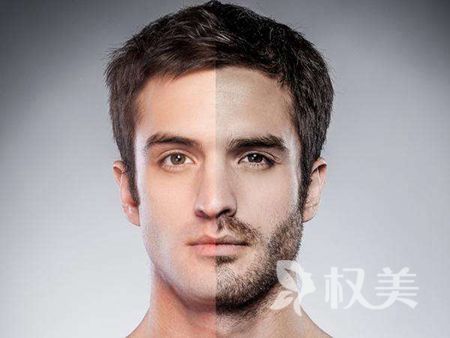 胡须种植哪里好 哈尔滨美佳娜植发医院胡须种植效果
