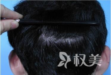 福州新生植发医院头发种植术效果好不好  术后如何护理