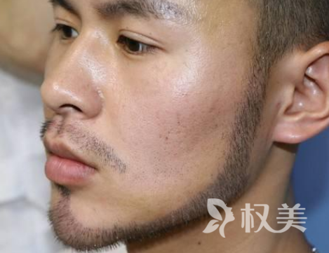 鬓角种植贵不贵 西安新锐国际植发医院效果永久吗