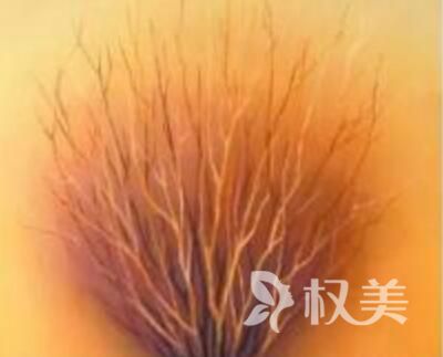 广州乐鬓毛发移植医院地址 阴毛种植效果好吗多少钱
