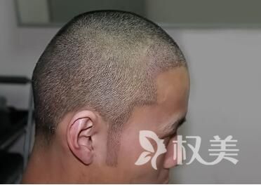 四川华美紫馨植发医院鬓角种植效果好吗  哪些人能做呢