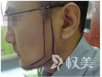 成都美立方植发医院鬓角种植有什么特点呢  会不会有后遗症