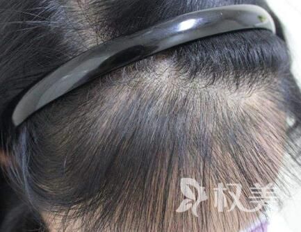 女性头顶头发稀少原因是什么 北京美莱种植头发技术怎么样
