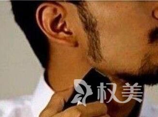 济南碧莲盛植发医院好不好 鬓角种植效果图