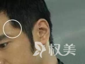 鬓角没头发怎么办 西安瑞丽诗做鬓角种植需要多少钱