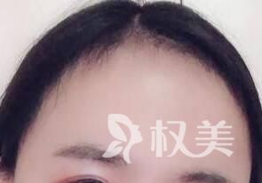 发际线过高怎么恢复 昆明碧莲盛做发际线种植效果如何