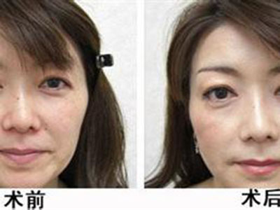 鼻子怎么样才能变漂亮