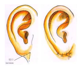 杯状耳矫正手术的优点 让耳部变得美丽自然