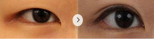 韩式无痕双眼皮的缺陷 韩式双眼皮的过程