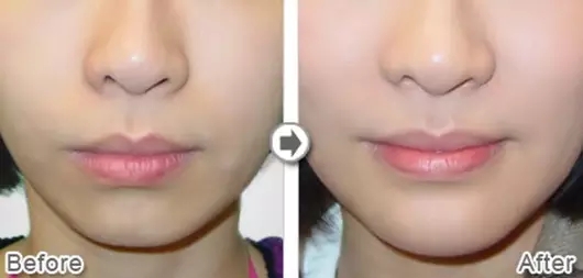 90%的女性微整形，竟然是为了转运？