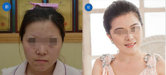北京幸福医整形医院眉毛种植案例