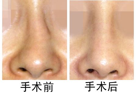 广州艾美歪鼻整形有哪些方法